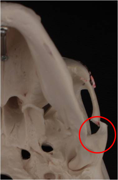 I had cheekbone surgery, but the back cheekbone remains. Is there a way to fix it? image 1