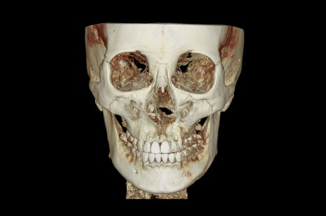 How Much Effect Does 230-Degree Zygoma Reduction Surgery Have? image 6