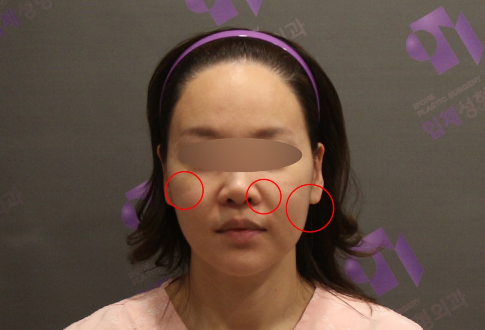 안면윤곽 볼처짐100%온다? 광대수술 부작용 총정리 | 上편 관련 이미지 5
