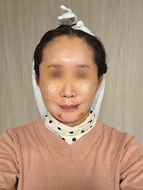 Facelift Recovery Period: When Will My Face Look Natural Again? image 2