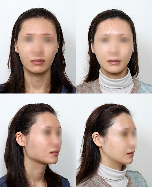 귀밑턱은 왜 중요할까? 안면윤곽수술에서 놓치기 쉬운 얼굴형의 핵심 관련 이미지 8