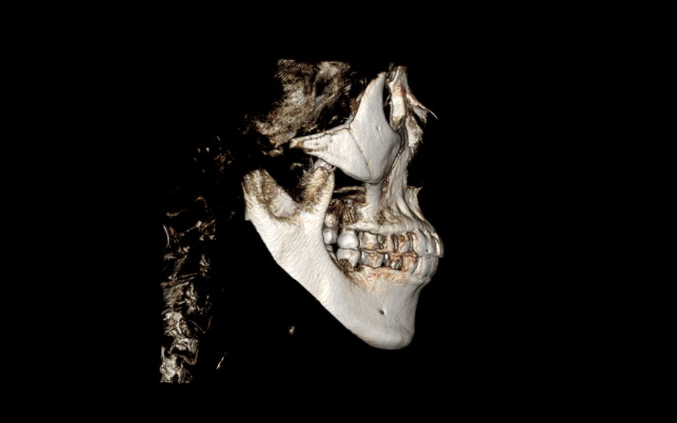 Consultation and Design Before Facial Contouring Surgery image 4