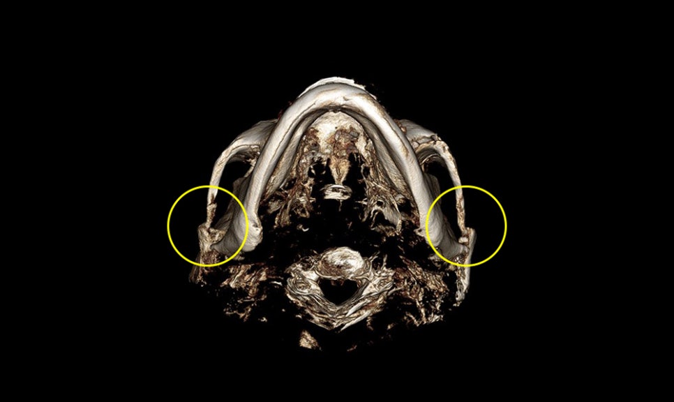 How Much Effect Does 230-Degree Three-Dimensional Zygomatic Reduction Have? image 2