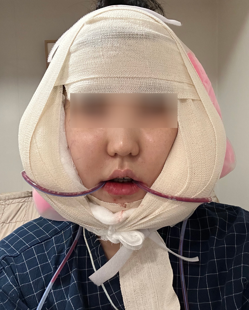 How Long Do Facial Contour Changes Continue After Facial Bone Contouring Surgery? (Day 1 to Day 365) — See With Photos image 3