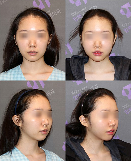 Will Summer Plastic Surgery, Especially Facial Contouring Surgery, Be Affected by the Season? image 3