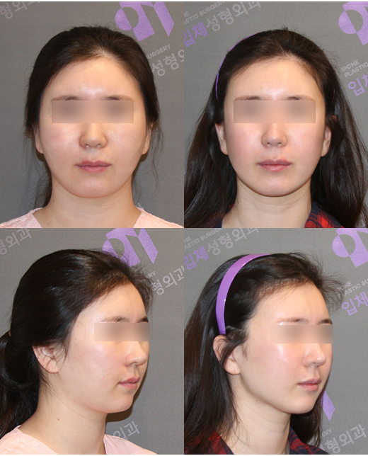 45도광대, 옆광대수술 후 광대재수술은 얼마나 효과가 있을까요? 관련 이미지 8