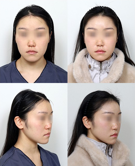 광대뼈 쉐이빙과 얼굴 처짐, 정말 관련이 있을까? 관련 이미지 6