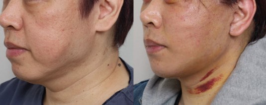 Amazing Changes Achieved with Contouring Facelift: A Facelift Technique That Even Addresses Asymmetry image 7