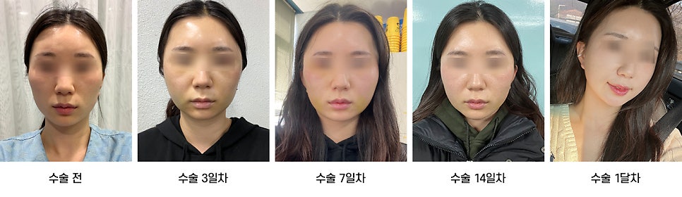안면윤곽 수술 후 붓기, 일상생활은 언제부터 가능한가요? 케이스별로 알아보기 관련 이미지 4