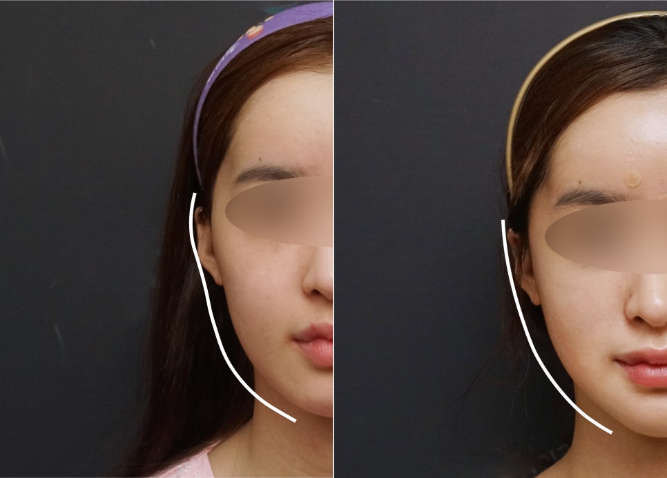 안면윤곽연예인, 연예인들은 왜 갈수록 예뻐질까요? - 성형외과 전문의가 직접알려드립니다. 관련 이미지 9