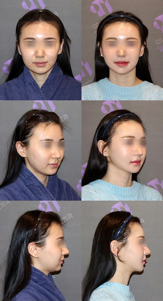 How Should Double Chin and Skin Sagging After Contouring Surgery Be Addressed? image 3
