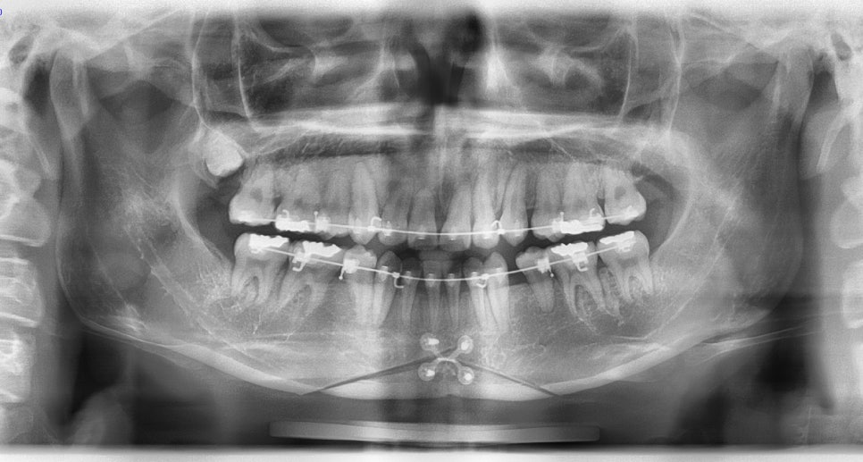 Is It Necessary to Remove the Fixation Pins After Facial Contouring Surgery? image 5