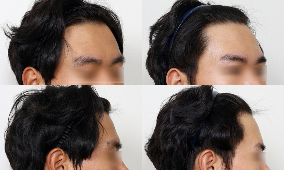 눈썹뼈돌출, 무조건 깎는 것이 답일까요? 눈썹뼈절삭부터 이마성형까지 관련 이미지 5