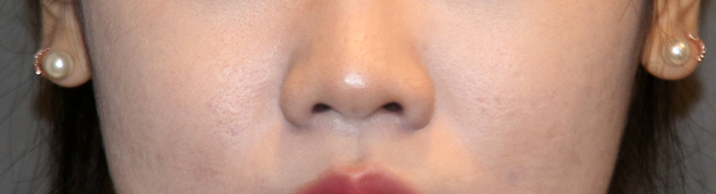 Is There a Nose Alar Reduction Surgery Without Scarring? (Looking at Before-and-After Photos) image 12