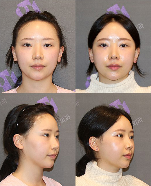 얼굴 비대칭, 한쪽만 윤곽수술 할 수 있나요? 관련 이미지 7