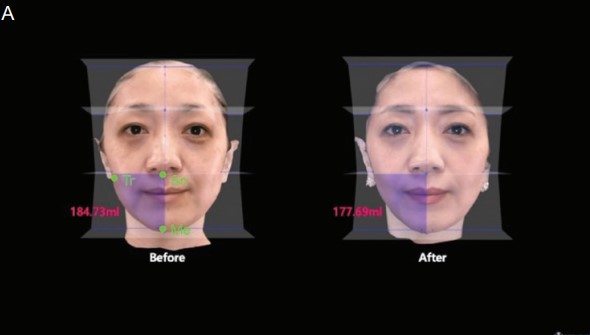 The Importance of Buccal Fat Removal in Facelift Surgery image 4