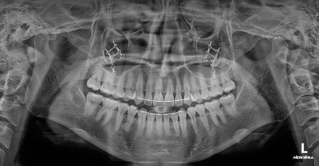What Side Effects Can Occur Due to Excessive Bone Resection in Facial Contouring Surgery? image 7