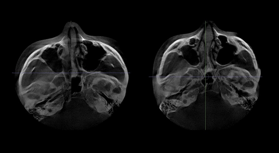 Non-fixation zygoma reduction surgery, will the bone heal properly? image 4