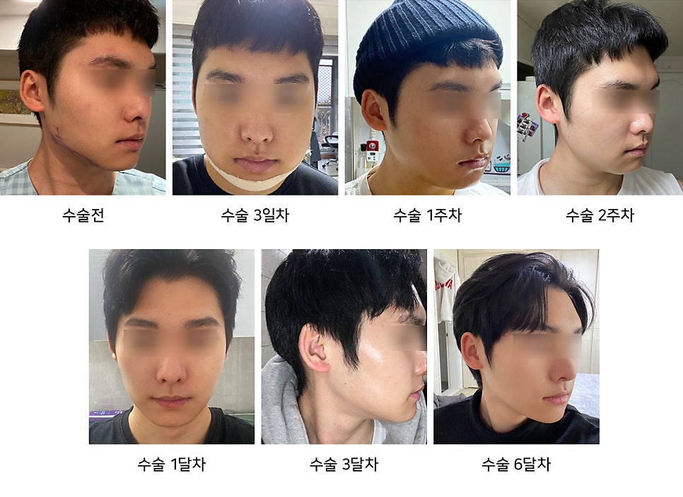 남자사각턱수술이 여자와 다른 이유는? 관련 이미지 8