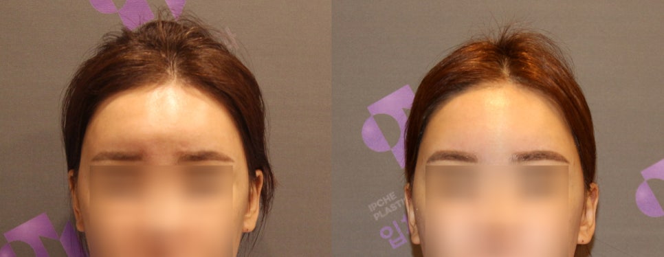 이마지방이식 제거 할 수 있을까요? 관련 이미지 8
