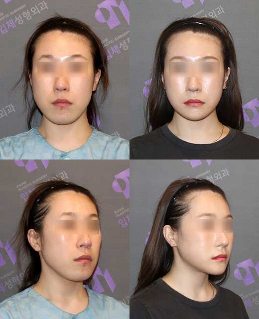 Is facial contouring surgery possible even at an older age? Important things you should know image 5