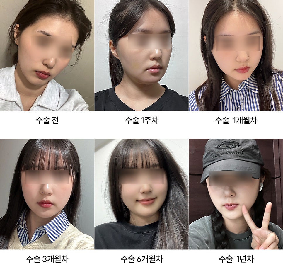 How Long Do Facial Contour Changes Continue After Facial Bone Contouring Surgery? (Day 1 to Day 365) — See With Photos image 11