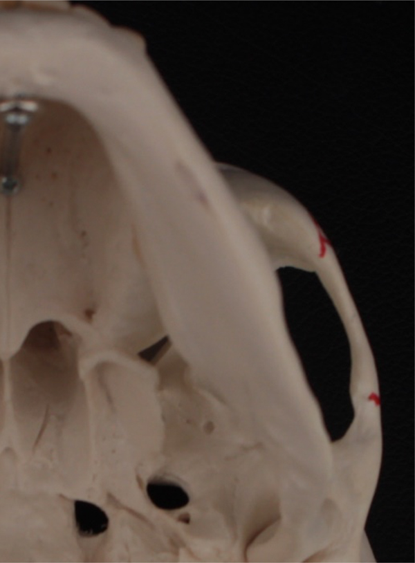 광대수술 후 이차각, 계단현상은 왜 생기는 걸까요? 관련 이미지 3