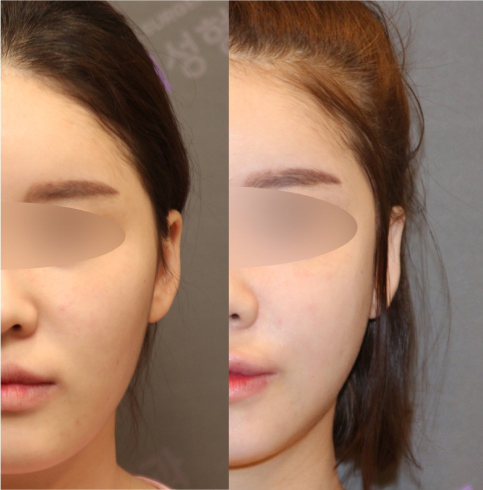 안면윤곽, 연예인 신세경처럼 예뻐질수 있을까요? -전문의가 알려드립니다. 관련 이미지 5