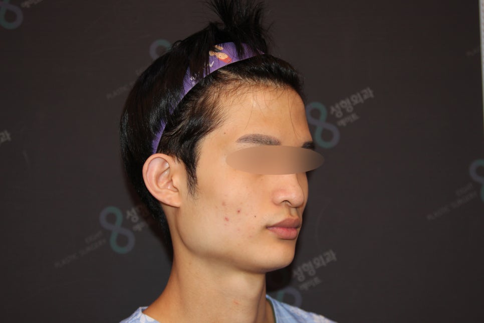Male Facial Contouring (Square Jaw Surgery, Cheekbone Surgery, Chin Surgery) - Explained by a Specialist image 2
