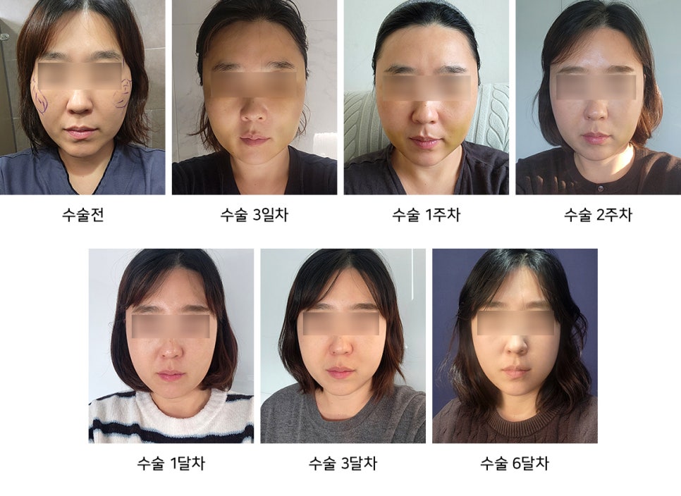 Eating, Exercise, and Swelling Management After Facial Contouring Surgery - Explained by a Specialist image 3