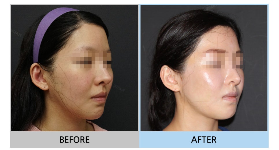 Considering revision cheekbone surgery, is it possible with a 230-degree three-dimensional cheekbone reduction as well? image 4