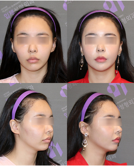 Cheek Sagging? Nonunion? Hollow Cheeks? A Complete Guide to 6 Side Effects of Zygoma Surgery image 3