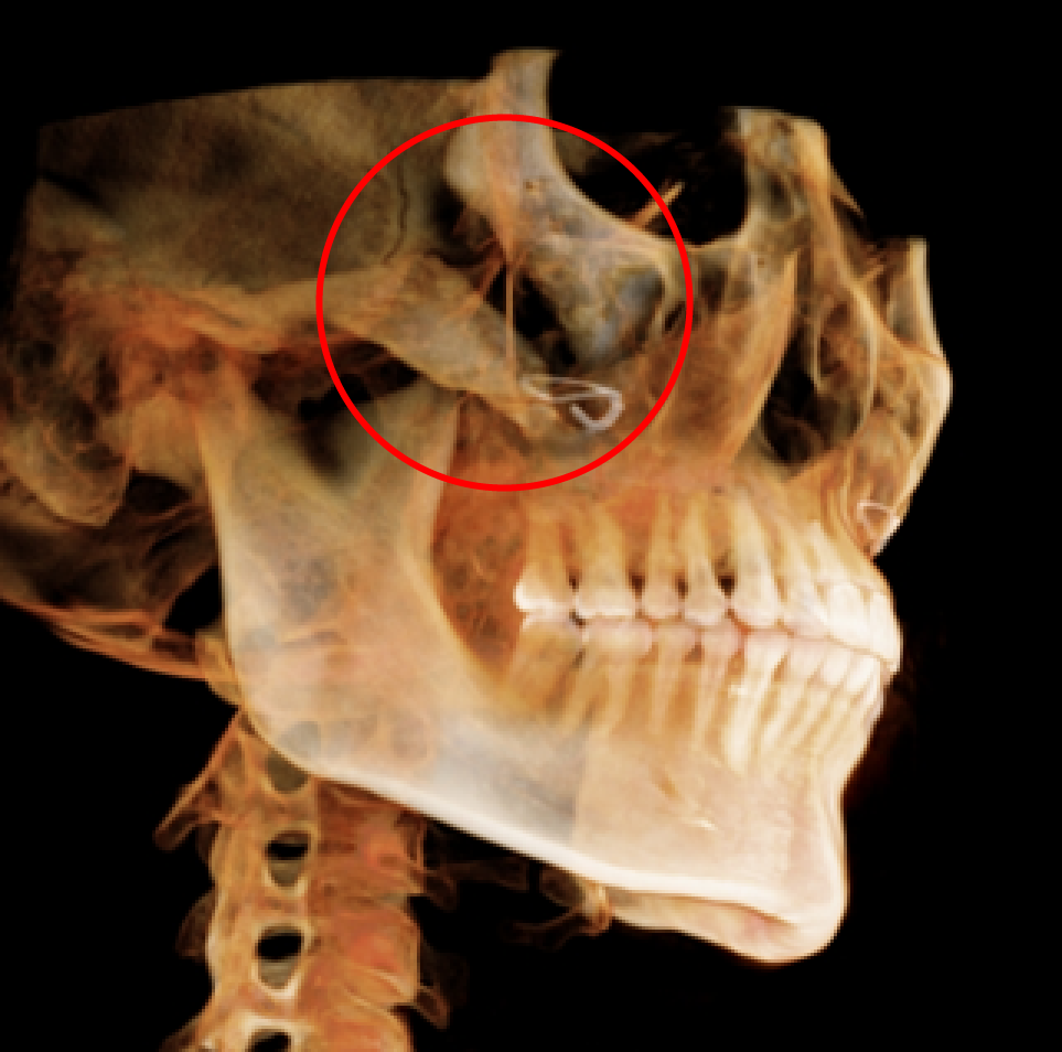 A Complete Summary of 6 Complications After Cheekbone Surgery: Sinusitis, Recurrence, Hollow Cheeks, and Sagging Cheeks image 2