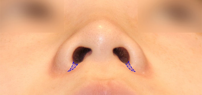 Incisional or Non-incisional? A Review of Alar Reduction Surgery Cases (Alar Base Reduction) image 5