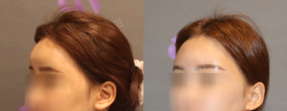 이마지방이식 제거 할 수 있을까요? 관련 이미지 9