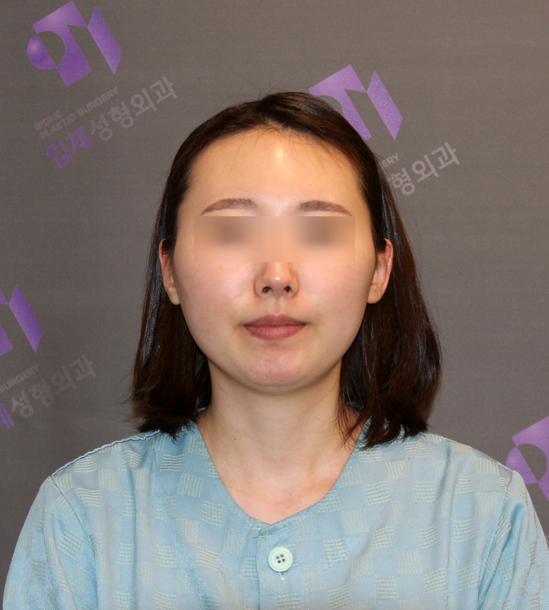 광대뼈 비대칭, 광대축소술로 교정할 수 있을까요? 관련 이미지 6
