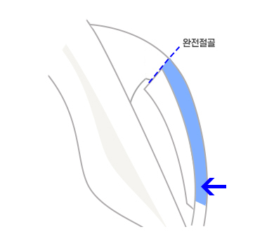 이런 분들은 230도입체광대축소술은 하지 마세요 관련 이미지 4