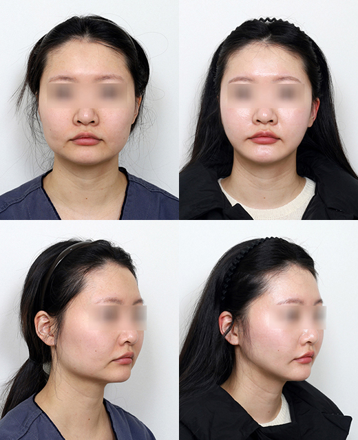 사각턱 유형에 따라 수술 효과가 달라진다? 말린 턱과 뻗친 턱의 차이 관련 이미지 2