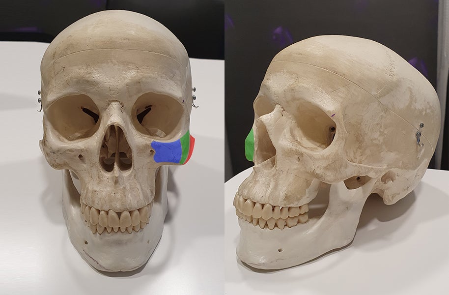 Does the Surgical Method Change Depending on the Protruding Cheekbone Location? Exact Locations and Diagnosis of the Front Cheekbone, Side Cheekbone, 45-Degree Cheekbone, and Back Cheekbone image 1