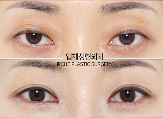 Surgery That Goes Well with Cheekbone Surgery, Part 1: Lateral and Lower Canthoplasty image 6