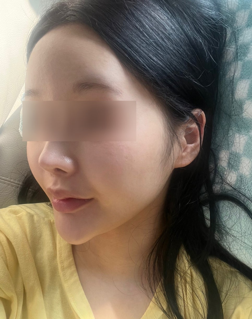 How Should Witch Chin Be Treated When You Smile? image 1