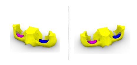 3D프린터 보형물을 이용한 안구함몰, 함몰눈 교정의 실제 사례 관련 이미지 8