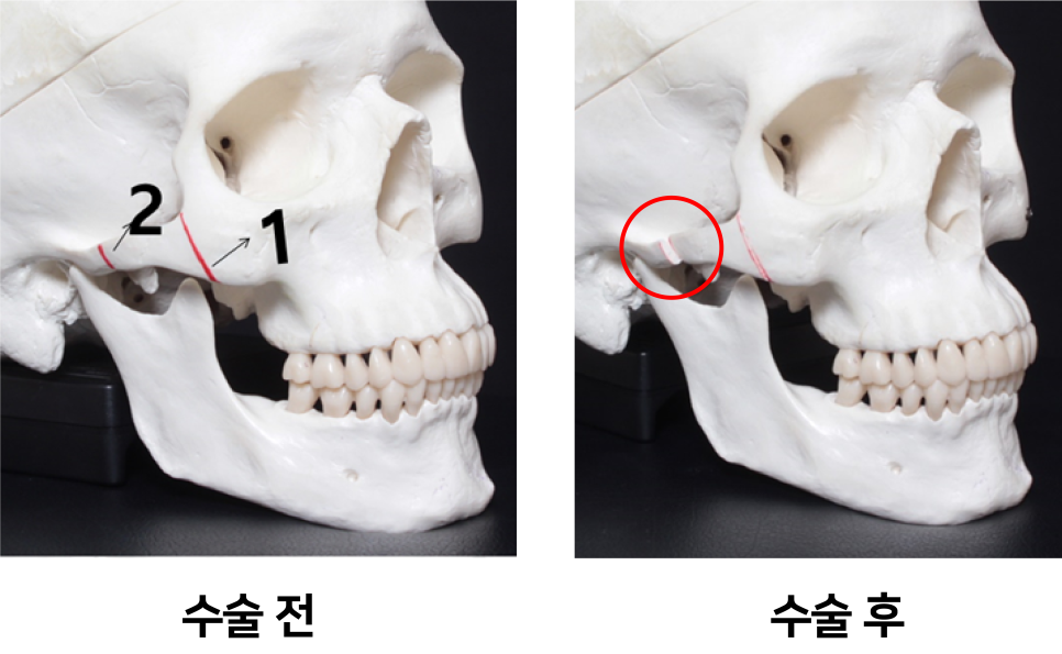 광대축소술 관련 이미지 3
