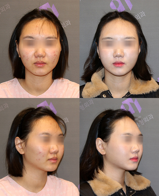 Square Jaw Surgery: What Are a Retracted Jaw and a Protruding Jaw? image 10