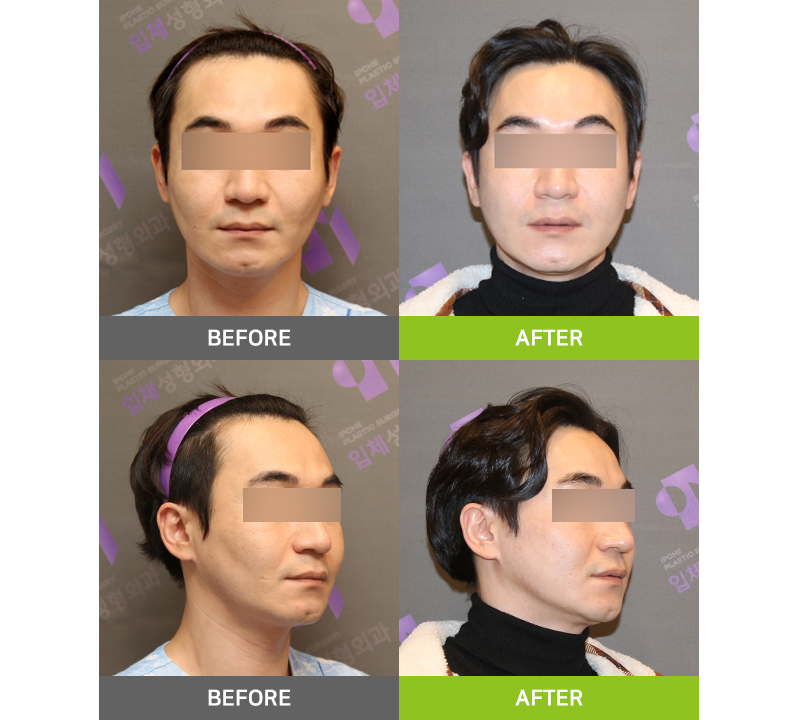 I had cheekbone surgery, but the back cheekbone remains. Is there a way to fix it? image 7