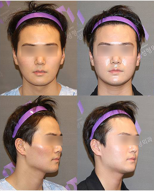 Will cheekbone reduction surgery also make the face smaller? : Learn about how to reduce prominent cheekbones with real surgical cases image 11