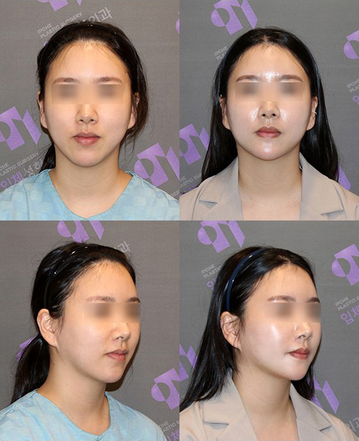Is There a Way to Address the Secondary Angle That Appears After Chin Surgery? image 5