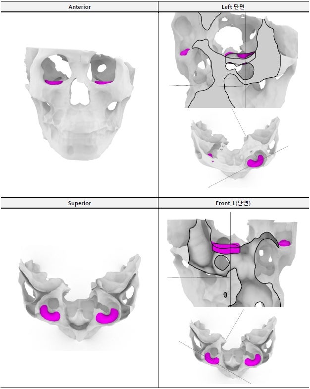 What Is the Best Way to Correct Deep-Set Eyes? image 3