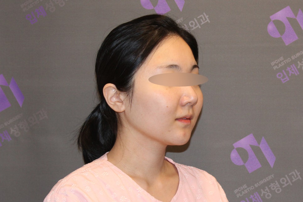 안면윤곽수술비용, 비쌀수록 좋은걸까요? -전문의가 알려드립니다. 관련 이미지 8
