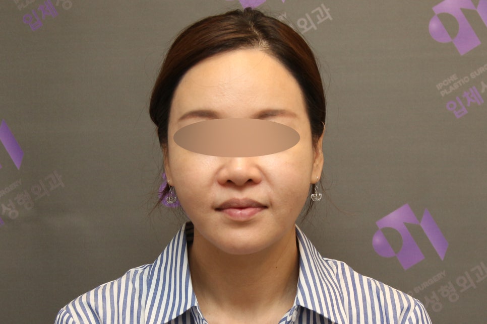 안면윤곽 볼처짐100%온다? 광대수술 부작용 총정리 | 上편 관련 이미지 6